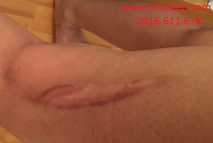 Trị sẹo xấu, lồi dưới da Trị sẹo xấu, lồi dưới da