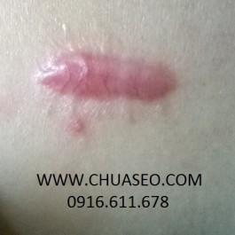 1001 kiểu sẹo và cách chữa trị sẹo