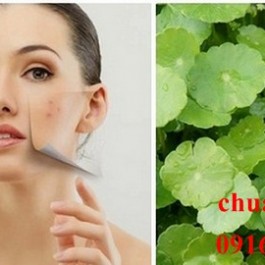 Cách trị sẹo lâu năm ở mặt dễ đến không ngờ