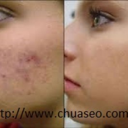 Cách trị sẹo lồi lâu năm an toàn hiệu quả nhất