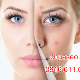 Cách trị sẹo lồi thâm bằng tinh dầu hoa tường vi