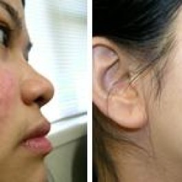 Sẹo mụn và cách điều trị