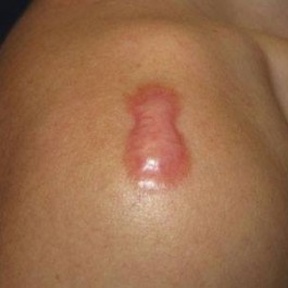 Tổng quan về sẹo và một số biện pháp ngăn ngừa sẹo hữu ích, thiết thực