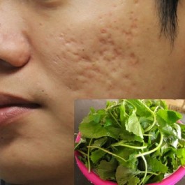 Trị sẹo lõm bằng rau má hiệu quả ngay tại nhà