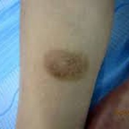 Trị sẹo thâm hiệu quả, giá rẻ bằng 4 loại nguyên liệu tự nhiên sẵn có quanh ta